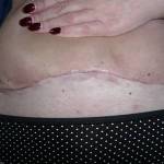 Tummy tuck with liposuction before and after (43)