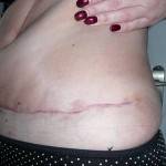 Tummy tuck with liposuction before and after (44)