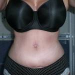 Tummy tuck with liposuction before and after (45)