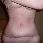 Tummy tuck with liposuction before and after (46)
