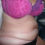 Tummy tuck with liposuction before and after (5)