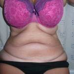 Tummy tuck with liposuction before and after (7)