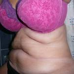 Tummy tuck with liposuction before and after (8)