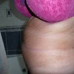 Tummy tuck with liposuction before and after (9)