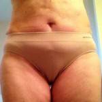 Tummy tuck with liposuction before and after belly