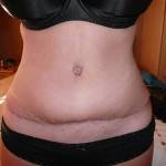 Tummy tuck with liposuction before and after best photo of surgeons