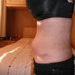 Tummy tuck with liposuction before and after cosmetic surgeons