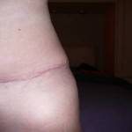 Tummy tuck with liposuction before and after images photos