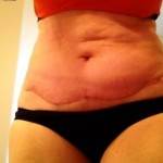 Tummy tuck with liposuction before and after one year