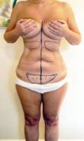 Tummy tuck with liposuction before and after photo