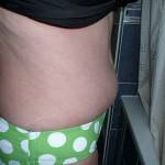 Tummy tuck with liposuction before and after pregnancy