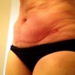 Tummy tuck with liposuction before and after scar image