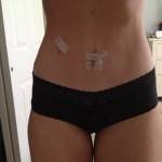 Tummy tuck with liposuction before and after scar strips
