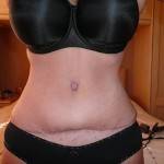 Tummy tuck with liposuction before and after top surgeons