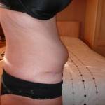 Tummy tuck with liposuction before and after top surgeons photo
