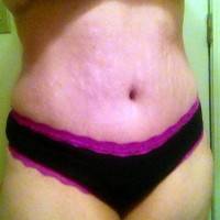 Weight loss after tummy tuck procedure liposuction