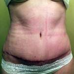 before and after abdominoplasty surgery tummy tuck photos
