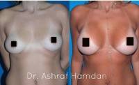 Breast reconstruction with tummy tuck before and after