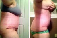 Breast reconstruction with tummy tuck before and after photo