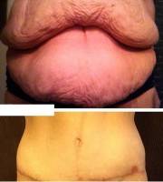 How to get rid of hanging skin tummy tuck before and after