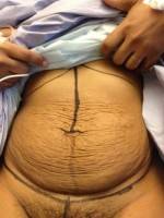 Laser treatment for stretch marks photo