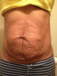 Treatment for stretch marks image