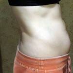 Tummy tuck images Baltimore best cosmetic surgeons photos