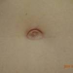 Tummy tuck images Mexico cosmetic surgeons pics