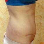 Tummy tuck images Mexico top best cosmetic surgeons photos