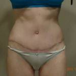 Tummy tuck images New York top best plastic surgeons pics