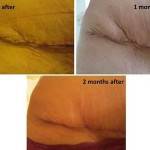 Tummy tuck images Tampa best cosmetic surgeons