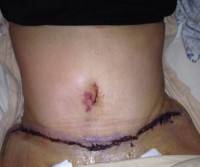 Tummy tuck images after baby