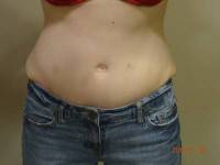 Tummy tuck images after pregnancy