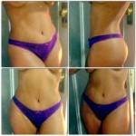 Tummy tuck images c section pic
