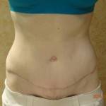 Tummy tuck images forum picture