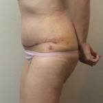 Tummy tuck images nyc top best cosmetic surgeons images