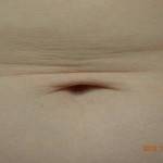 Tummy tuck images nyc top best plastic surgeons pictures