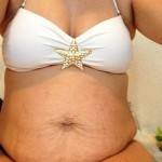 Tummy tuck images nyc top best surgeons