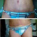 Tummy tuck images of belly button pics