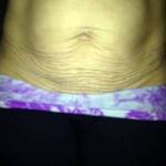 Tummy tuck images of c section images