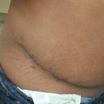 Tummy tuck images of revision photo