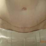 Tummy tuck images procedure pic