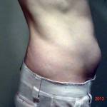 Tummy tuck images realself picture