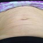 Tummy tuck images scar recovery pic