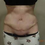 Tummy tuck images scar treatment pics