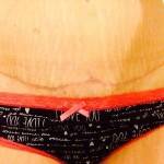 Tummy tuck images with lipo photo