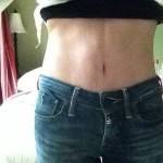 Tummy tuck images with liposuction surgery photo