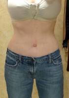 Tummy tuck surgery procedure after photo