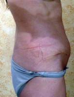 Tummy tuck surgery procedure scar after'