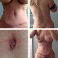 Tummy tuck surgery without liposuction
